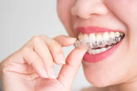 Invisalign Aligners Al Ain