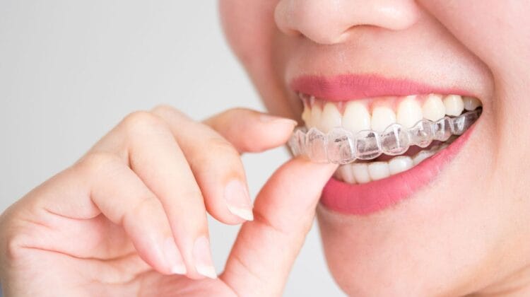 Invisalign Aligners