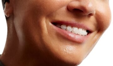 Ceramic White Braces