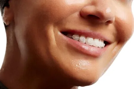 Ceramic White Braces Al Ain