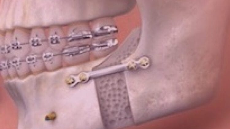 Orthognathic Surgeries