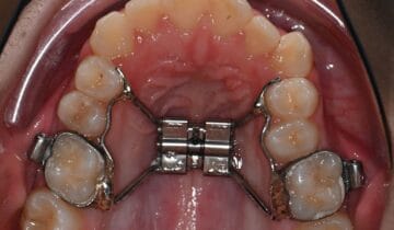 Rapid Maxillary Expansion