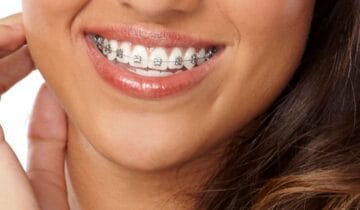 Self-ligating braces