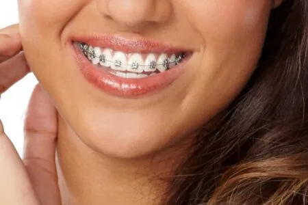 Self-ligating Braces Al Ain