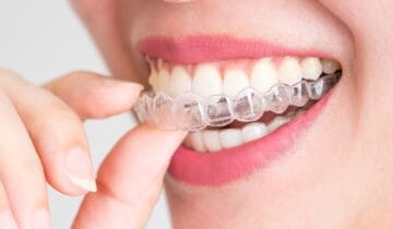 Transparent Aligners