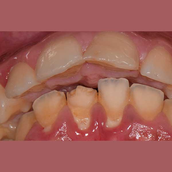 3-before-2-put it between. before and after_0