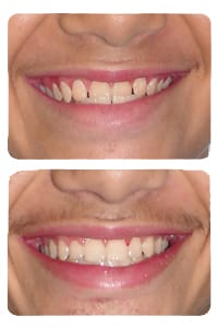 النتيجة بعد علاج العضة المعكوسة على يد الدكتور خالد الكاتب