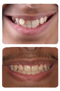 النتيجة بعد علاج العضة المعكوسة والازدحام على يد الدكتور خالد الكاتب