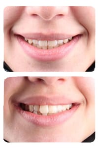 النتيجة بعد العلاج بالتقويم الشفاف انفيزلاين على يد الدكتور خالد الكاتب