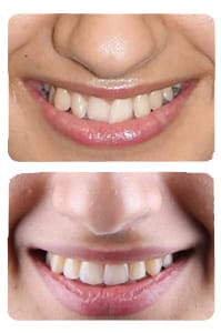 النتيجة بعد توسيع الفك وإغلاق فراغ ضرس على يد الدكتور خالد الكاتب