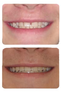 النتيجة بعد إغلاق فراغات الأسنان على يد الدكتور خالد الكاتب