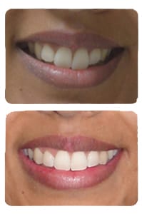 النتيجة بعد إعادة علاج تقويم الأسنان على يد الدكتور خالد الكاتب