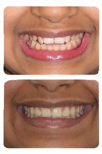 النتيجة بعد علاج العضة المفتوحة وتوسيع الفك على يد الدكتور خالد الكاتب