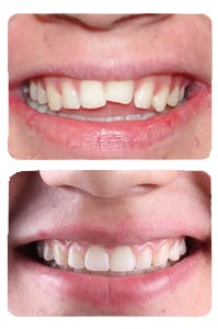 النتيجة بعد علاج العضة المفتوحة بالتقويم على يد الدكتور خالد الكاتب