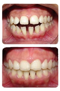 النتيجة بعد علاج العضة المفتوحة والبروز على يد الدكتور خالد الكاتب