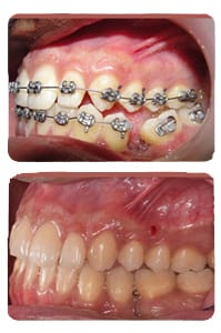 النتيجة بعد تعديل الأضراس المائلة والمنطمرة على يد الدكتور خالد الكاتب