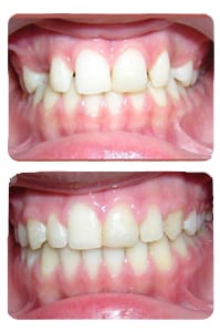 النتيجة بعد علاج الناب المنطمر على يد الدكتور خالد الكاتب