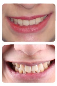 النتيجة بعد علاج العضة العميقة وفتح مسافة للزراعة على يد الدكتور خالد الكاتب