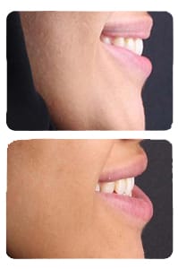 النتيجة بعد الجراحة التقويمية للفك السفلي على يد الدكتور خالد الكاتب