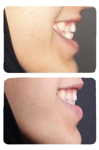 النتيجة بعد علاج ازدحام الأسنان الشديد على يد الدكتور خالد الكاتب