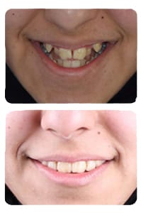 النتيجة بعد رصف الأسنان بدون خلع على يد الدكتور خالد الكاتب