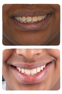 النتيجة بعد علاج بروز الأسنان على يد الدكتور خالد الكاتب