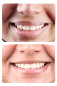 النتيجة بعد علاج بروز الأسنان المضاعف على يد الدكتور خالد الكاتب