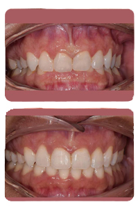 النتيجة بعد علاج العضة العميقة على يد الدكتور خالد الكاتب