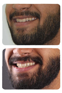 النتيجة بعد علاج العضة المعكوسة الأمامية على يد الدكتور خالد الكاتب