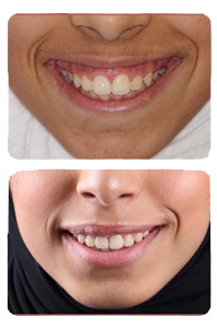 النتيجة بعد علاج بروز الأسنان على يد الدكتور خالد الكاتب