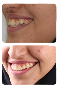 النتيجة بعد علاج ازدحام الأسنان على يد الدكتور خالد الكاتب