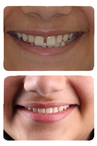 النتيجة بعد علاج الفراغات على يد الدكتور خالد الكاتب