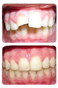 النتيجة بعد علاج بروز الأسنان بالجهاز الوظيفي على يد الدكتور خالد الكاتب