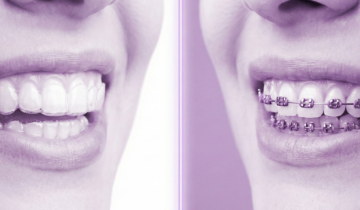 التقويم الشفاف أم المعدني؟ دليلك لاختيار النوع الأنسب لابتسامتك