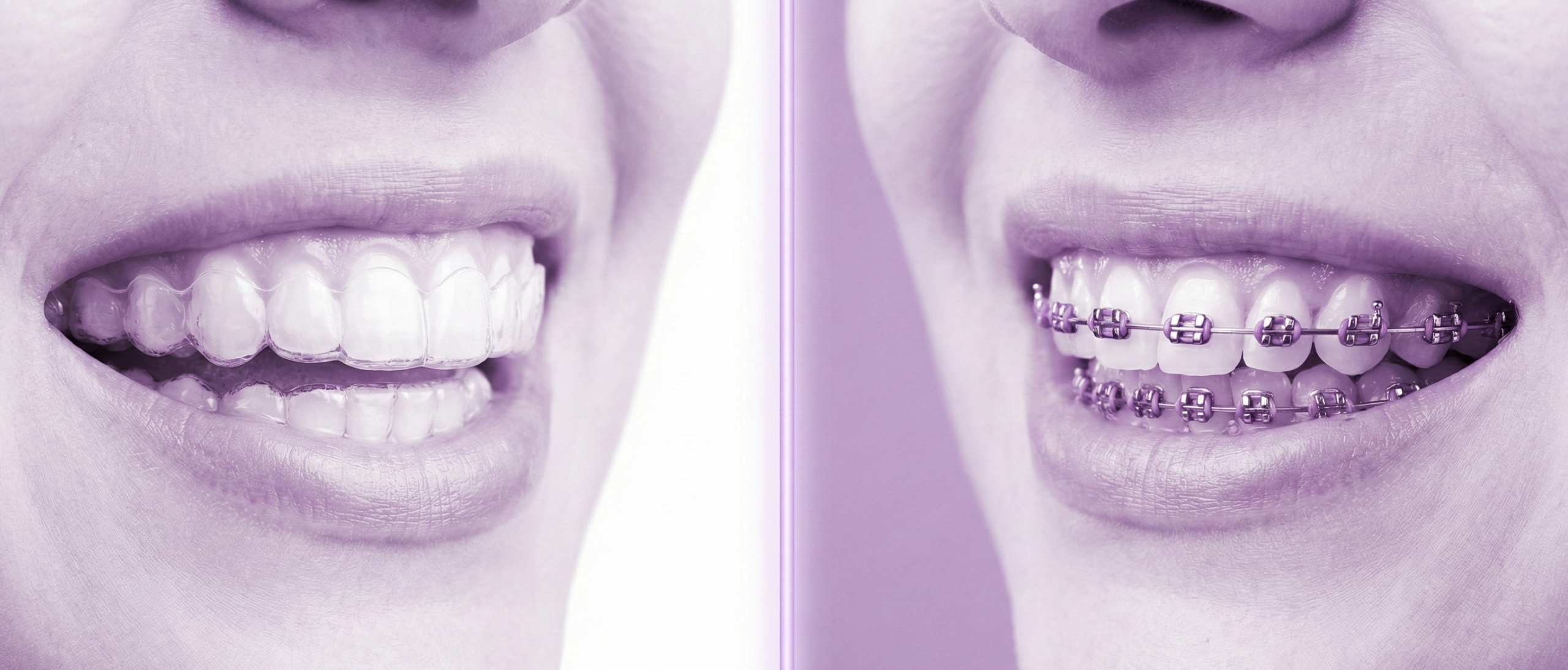 التقويم الشفاف أم المعدني