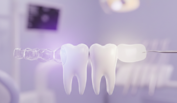 علاج فراغات الأسنان في العين: التقويم أم الفينير؟ دليلك للحل النهائي