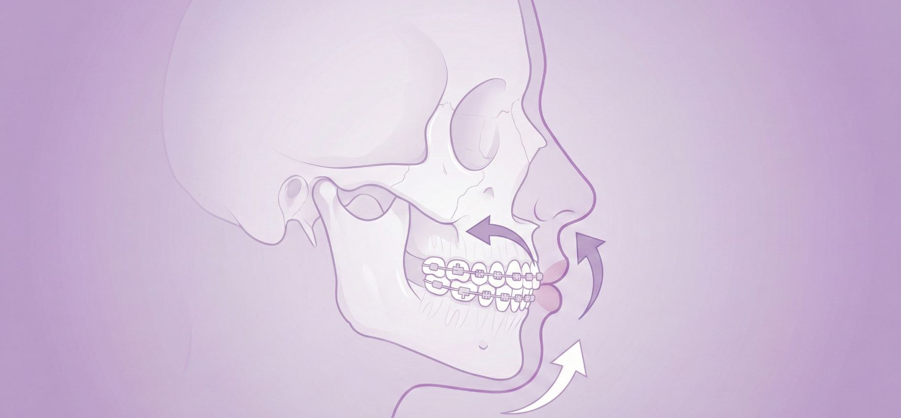 تغير-ملامح-الوجه-قبل-وبعد-التقويم-دكتور-خالد-الكاتب. صورة قبل وبعد توضح تأثير تقويم الأسنان على تحسين بروفايل الوجه، الذقن، وتناسق الأنف والشفاه في عيادة الدكتور خالد الكاتب، الأمين العام لجمعية الإمارات لتقويم الأسنان.