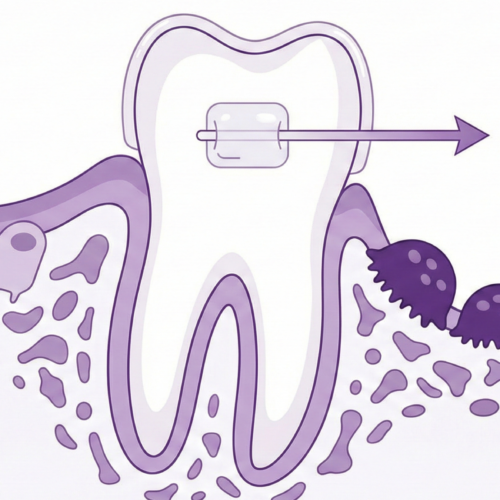 تقويم الأسنان في العين